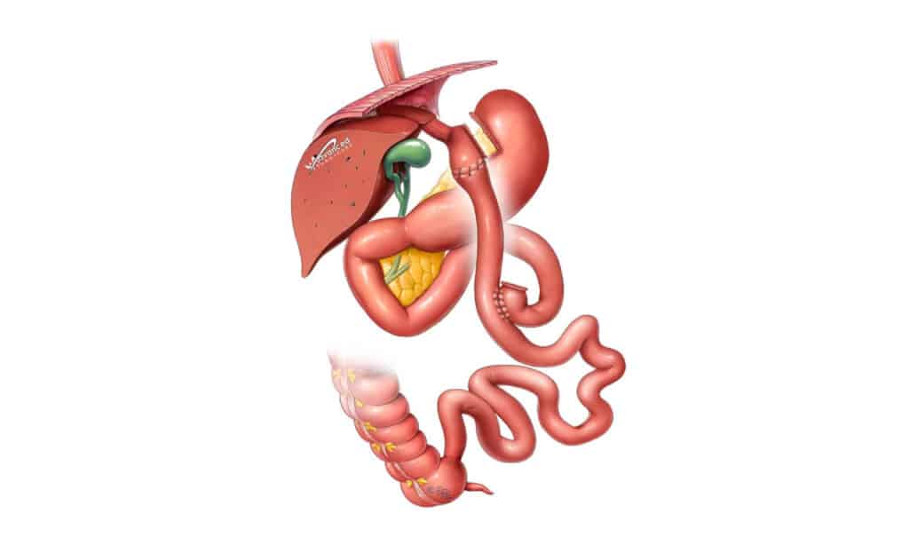 Gastric Bypass Revision Advanced Surgicare